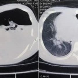 Noncontrast chest CT scan showed hydropneumothorax with left lung ...