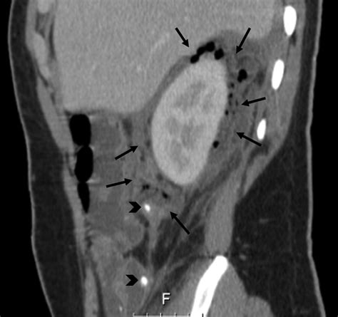 Perinephric abscess due to acute appendicitis - Surgery