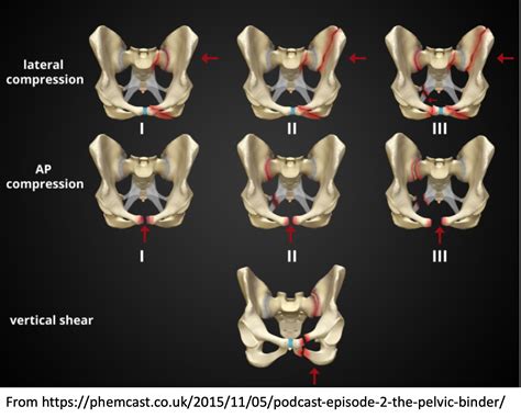 Classification Of Pelvic Fracture