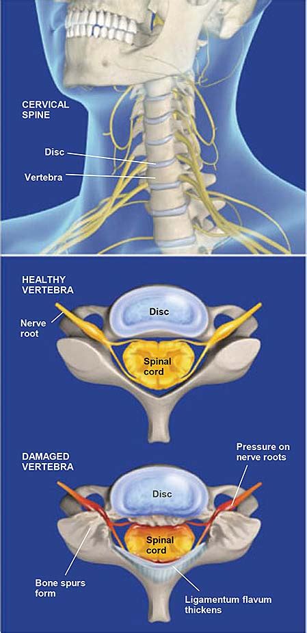 Estenosis espinal (cervical) | Grupo médico ortopédico de la costa central