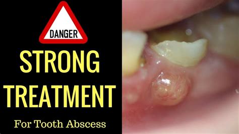 8 Images Tooth Abscess Treatment Homeopathic And Description - Alqu Blog