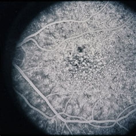 Basal Laminar Drusen Cuticular - Retina Image Bank