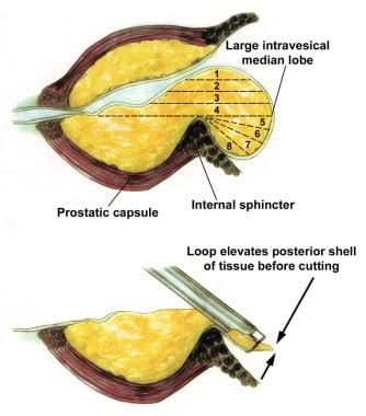 Transurethral Resection of the Prostate: Overview, Treatment ...