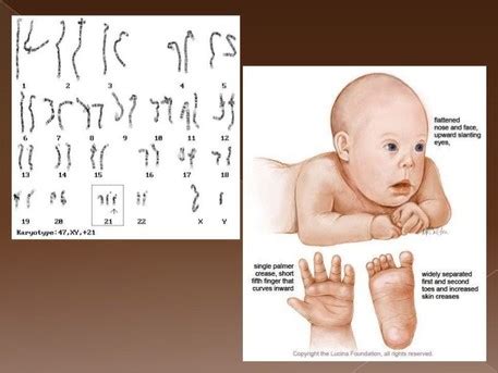 Chromosomal Abnormalities - Schizophrenia