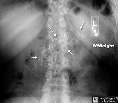 Chronic Pancreatitis With Glandular Calcification And Dilated 3A9