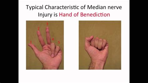 Nerve: Damage To Radial Nerve