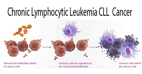 The Signs and Symptoms of CLL - My Health Line Blog - Health Fitness ...