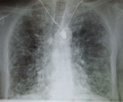 Signs & symptoms of pulmonary fibrosis – What is Pulmonary Fibrosis?