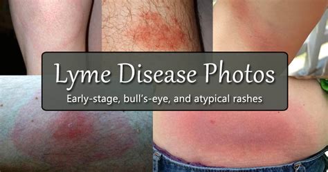 Lyme Disease Rash Photos: Early-Stage, Bull’s-Eye, and Atypical Rashes ...