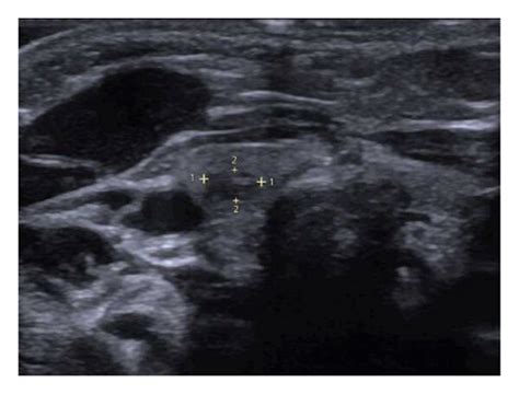 Ultrasound of the neck demonstrating 3.7 × 2.0 × 3.1 mm nodule in the ...