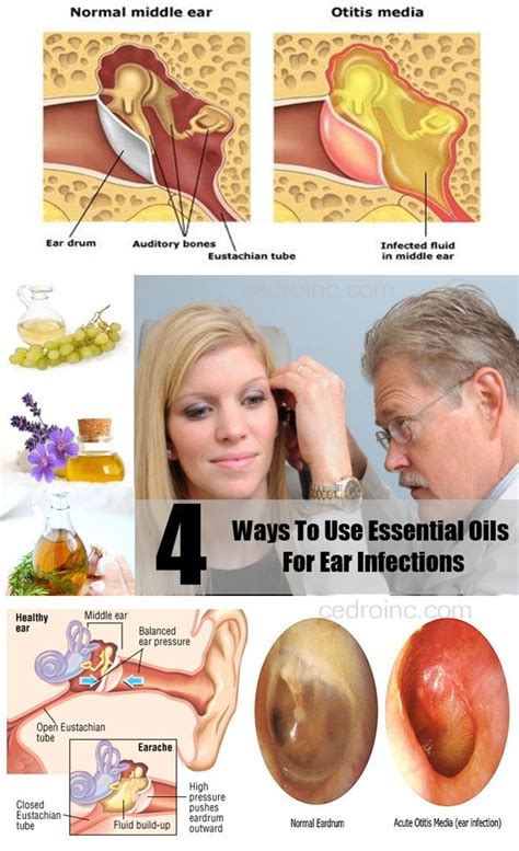 Home Remedies for Ear Infection | Ear infection home remedies, Home ...