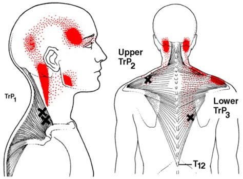 The Definitive Guide to Upper Trapezius Anatomy, Exercises & Rehab