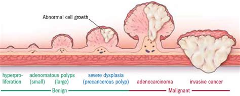 Colon Polyps Pictures - harcines