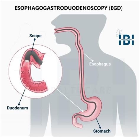 EGD | Upper GI Endoscopy - Gastrointestinal Tract Examination