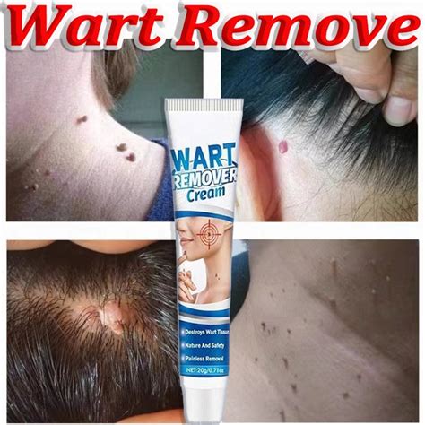 Warts Remover Cream Hand & Foot Verruca Removal Cream Treat Body Warts ...