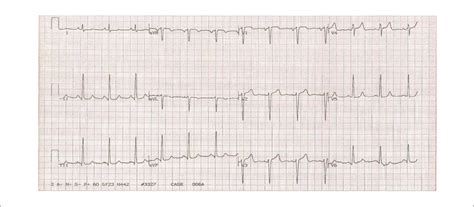 Unstable Angina Ecg