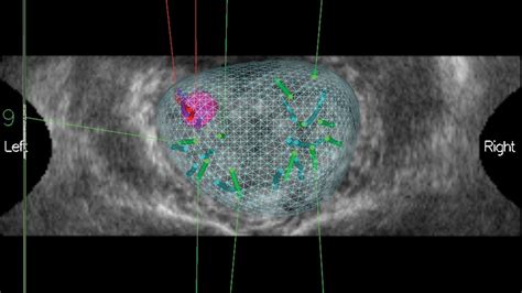 Another Win for MRI and Targeted Prostate Biopsy | MedPage Today