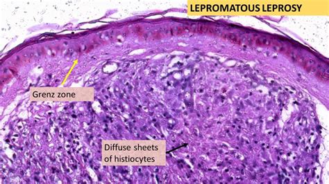 LEPROSY- Tuberculoid & Lepromatous | Pathology Made Simple