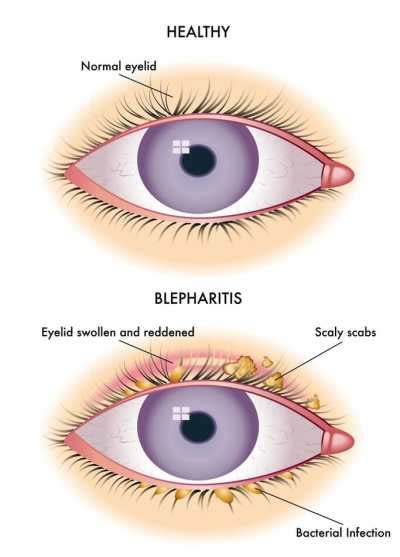 Crusty Eyes - TheraLife