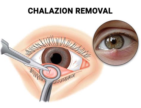 Chalazion Specialists in NYC - Vitreous Retina Macula Consultants of ...