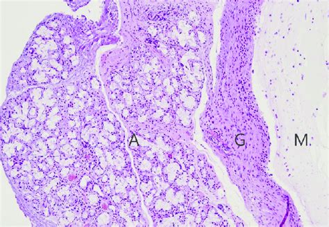 Mucocele Histology