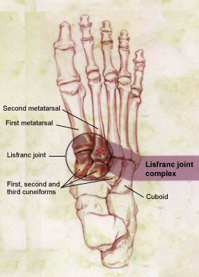 Lisfranc Injury of the Foot: A Commonly Missed Diagnosis | AAFP