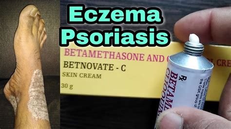 Eczema Psoriasis | Betnovate C Skin Cream - YouTube