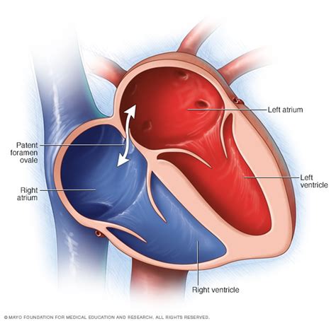 Patent foramen ovale - Symptoms and causes - Mayo Clinic