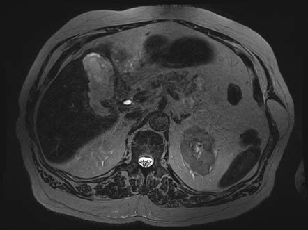 Gallbladder perforation | Image | Radiopaedia.org