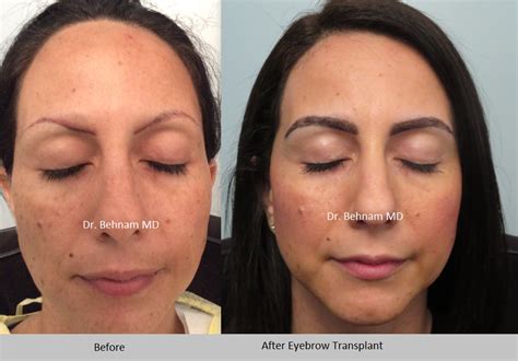 Eyebrow Transplant Los Angeles - Eyebrow Restoration | Dr. Sean Behnam