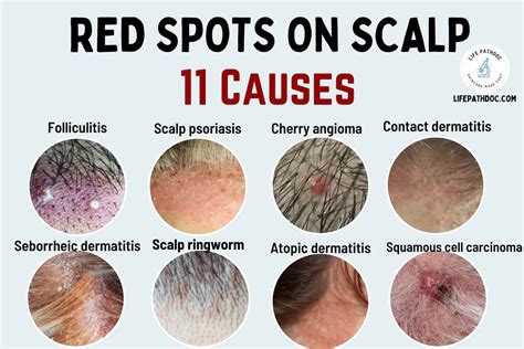 Red Spots on Scalp: 11 Causes, Pictures and Treatment