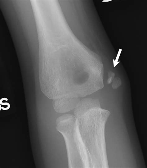 Elbow Grease Lateral And Medial Condyle Fractures Of The Humerus | The ...