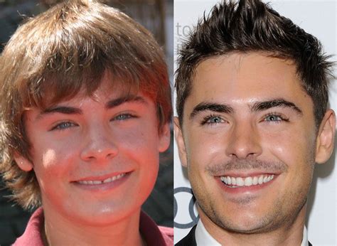 Zac Efron Celebrity Teeth, Celebrity Smiles, Celebrity Plastic Surgery ...