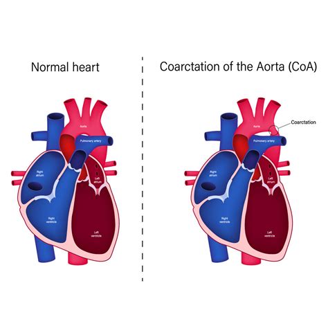 Top 9 Warning Signs of Aortic Coarctation | Vejthani