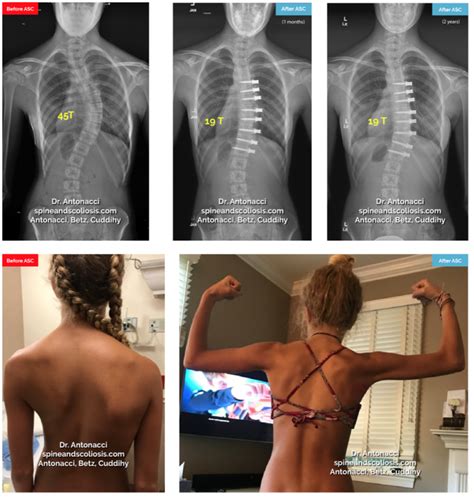 Before and After Scoliosis Surgery with Darryl Antonacci