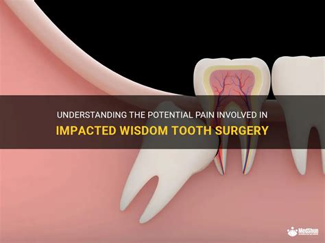 Understanding The Potential Pain Involved In Impacted Wisdom Tooth ...