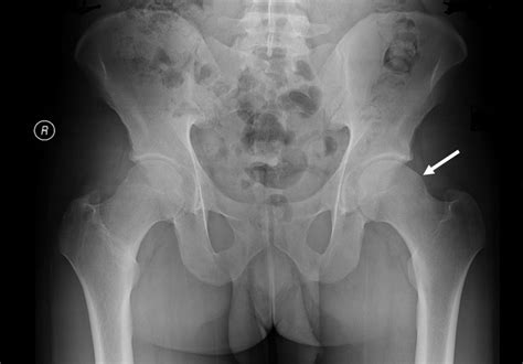 [Figure, AP pelvis x-ray demonstrating a...] - StatPearls - NCBI Bookshelf