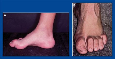 Foot and Ankle Deformities | Musculoskeletal Key