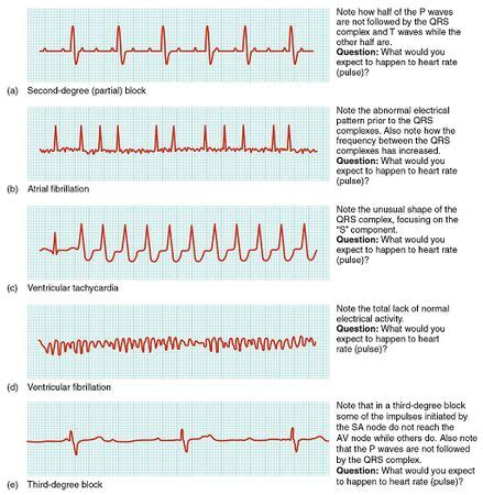 Heart Arrhythmias - Physiopedia