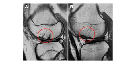 a 15-year-old male patient with fixation of a multifragmented chondral ...