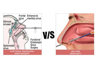 Functional Endoscopic Sinus Surgery Versus Balloon Sinuplasty: Which ...