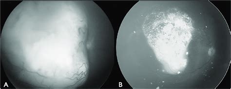 Intra-arterial chemotherapy for large retinoblastoma. Intra-arterial ...