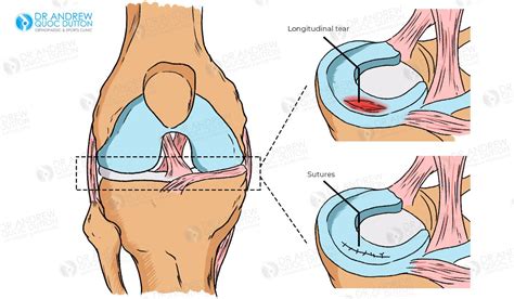 Meniscus Tear of the Knee: Surgery, Treatment & Recovery Time