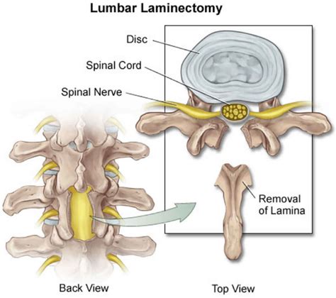 Back surgery, lower back surgery, indications, types, risks & complications