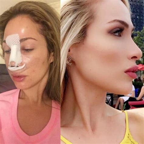 Bulbous Rhinoplasty Before And After » Rhinoplasty: Cost, Pics, Reviews ...