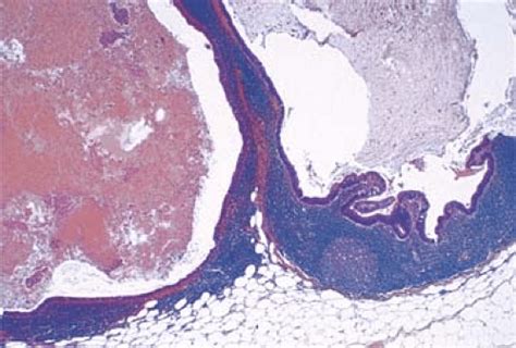 Metastatic Mucinous Adenocarcinoma | Basicmedical Key