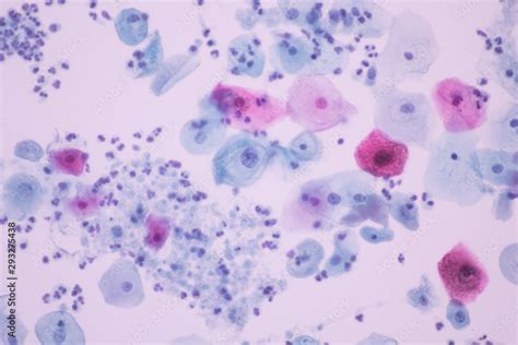 Trichomonas in pap smear on white background view in microscopic ...