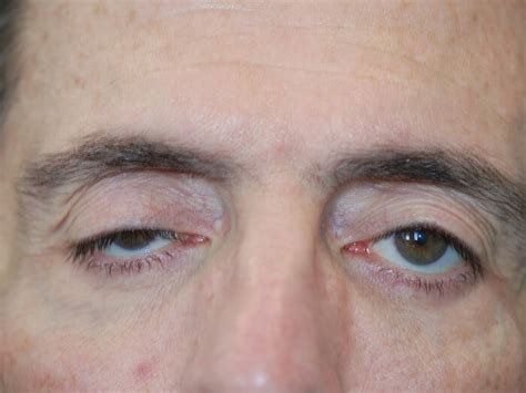 Palpebral Ptosis: Types, Symptoms, Causes, Risk Factors, Diagnosis and ...