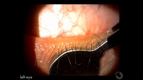 Meibomian gland expression EXPLAINED - YouTube