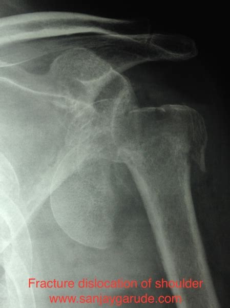 Shoulder Arthroplasty (Replacement) | Dr. Sanjay Garude